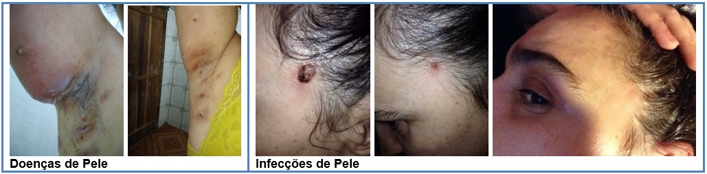 Natuoz óleo de Girassol ozonizado!#acne #tratamentopeleacneica #ozonio